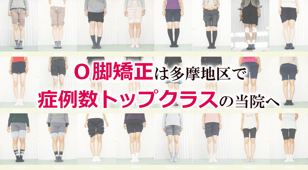 立川・八王子・日野・昭島・多摩地区のO脚矯正