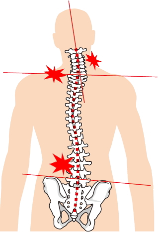 背骨と骨盤の歪み