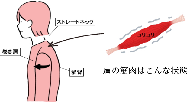 ストレートネックは肩こりの原因