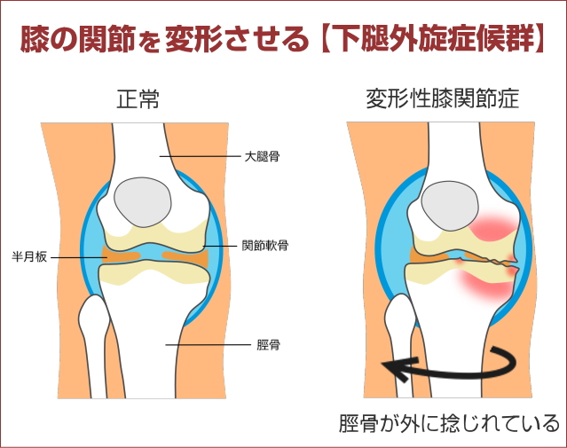 変形性膝関節症