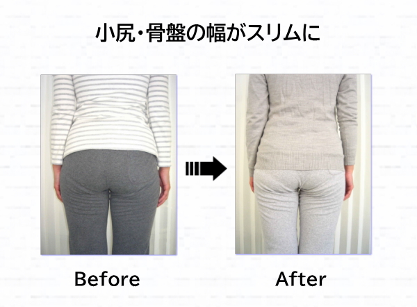 骨盤矯正ビフォーアフター 骨盤矯正ビフォーアフター